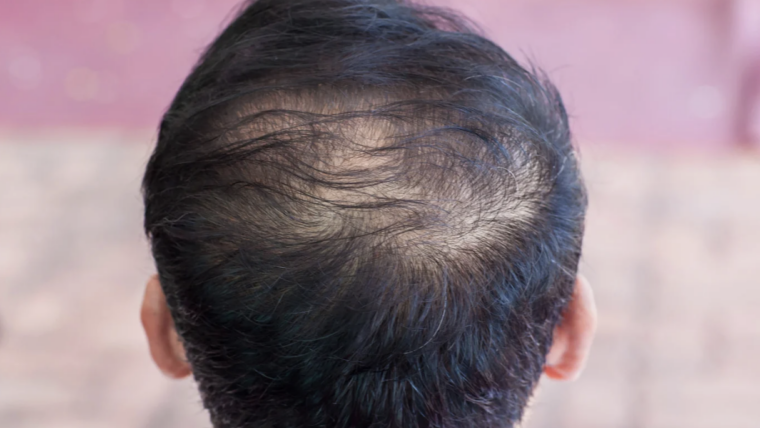 Find the Best Hair Loss Doctor in Maryland for Thinning Hair
